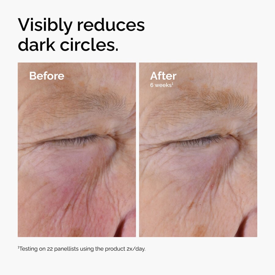 Before and after close-up showing visibly reduced dark circles after using Caffeine Solution 5% + EGCG.